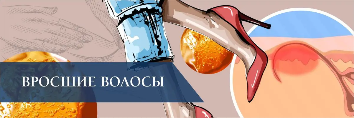 Вросшие волосы Вросшие волосы