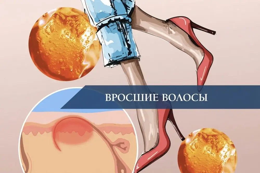 Вросшие волосы